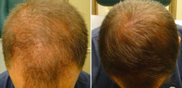 PRP Capelli Savona
