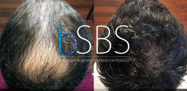 PRP Capelli