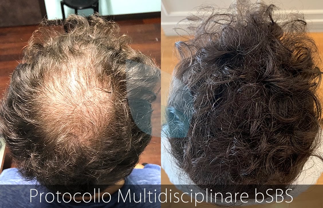 Medicina Rigenerativa Calvizie Ferrara