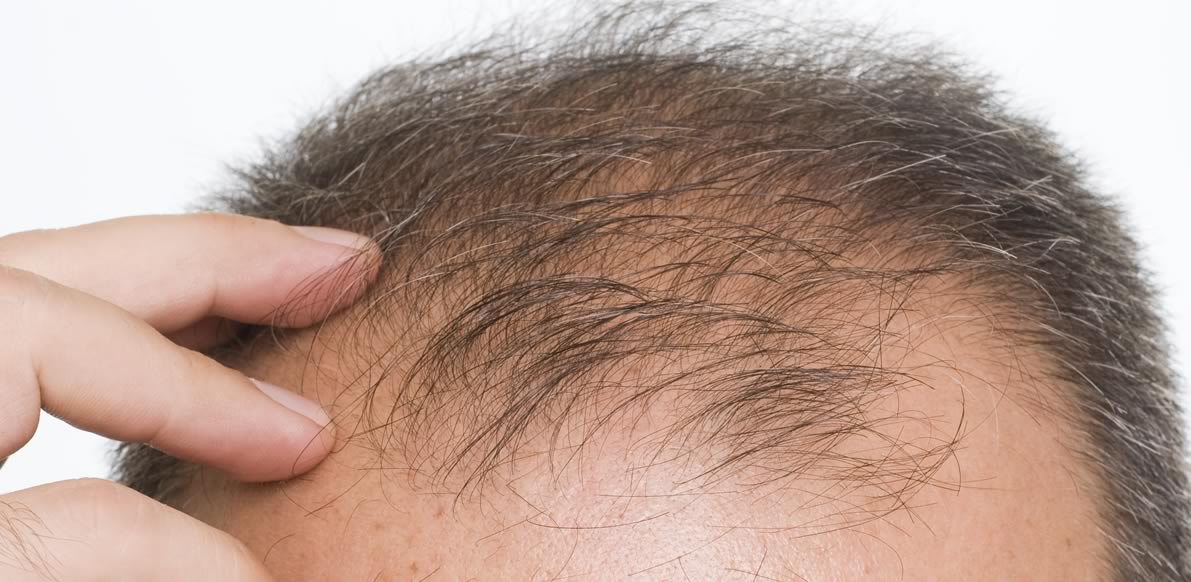 Capelli diradati e fini