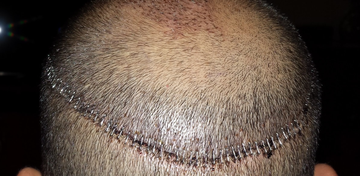Trapianto Capelli con megasessioni