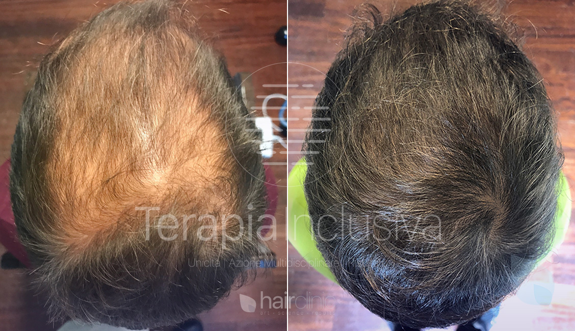 Infoltimento capelli uomo