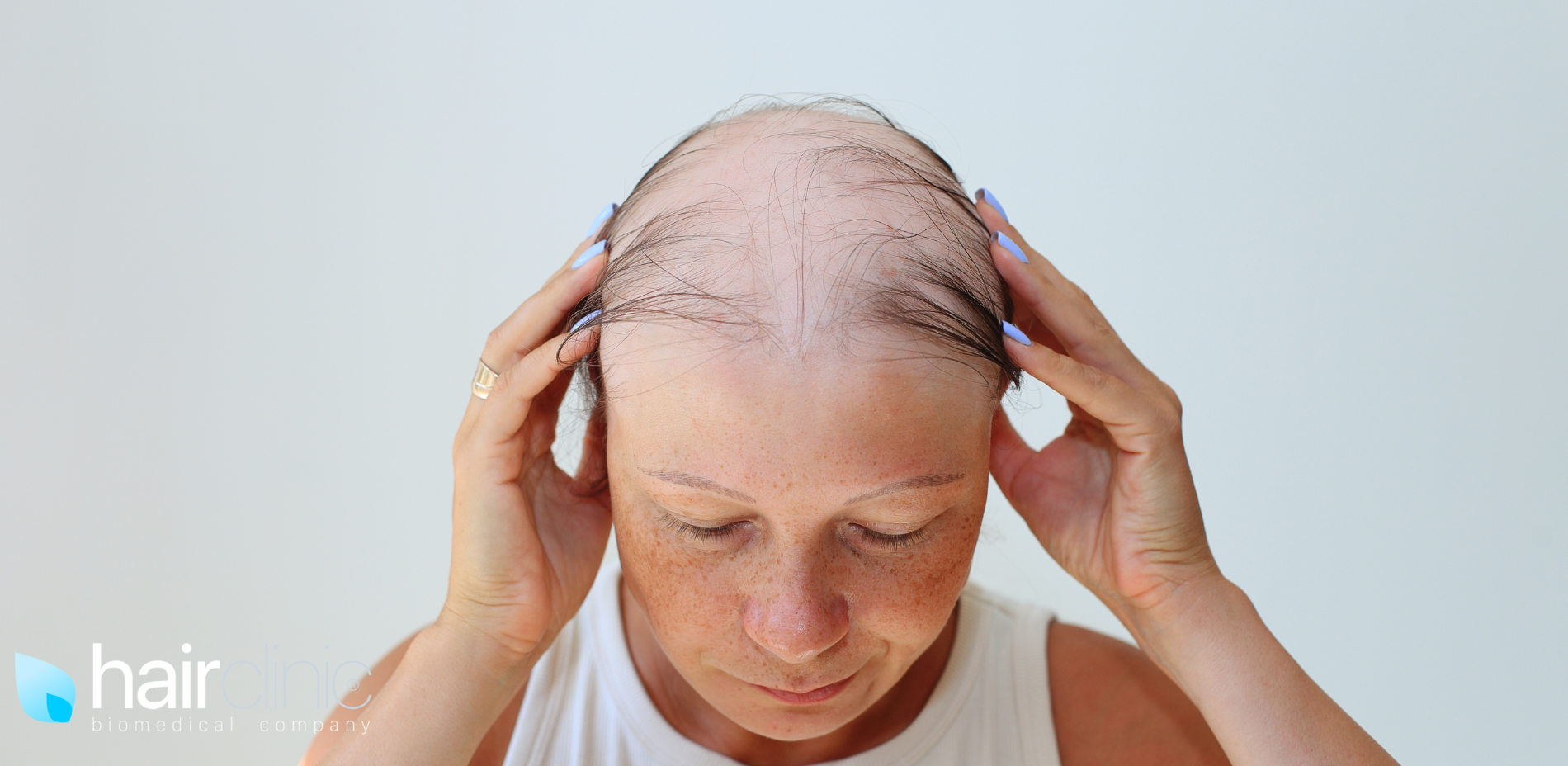 donna con alopecia areata