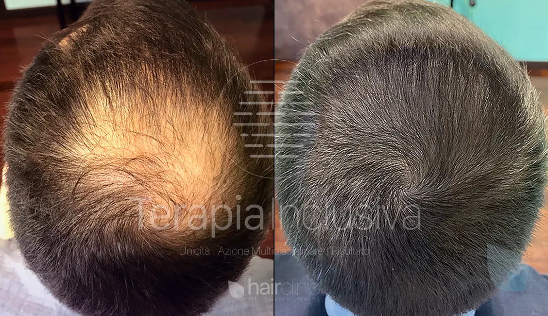 Alternativa al trapianto capelli