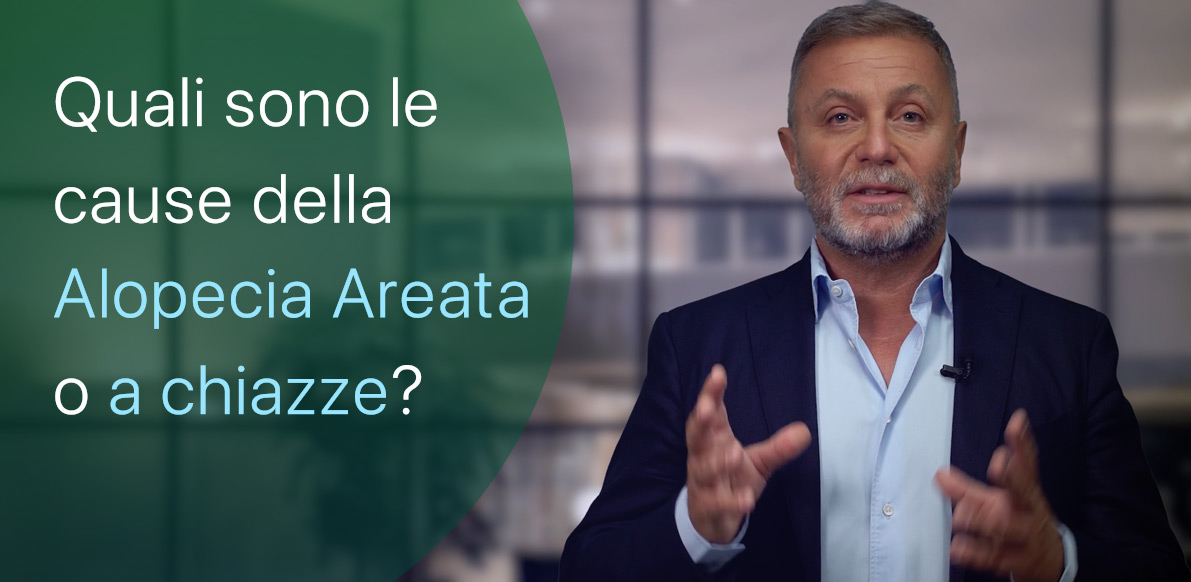 Ho l’Alopecia Areata, quali sono le cause?