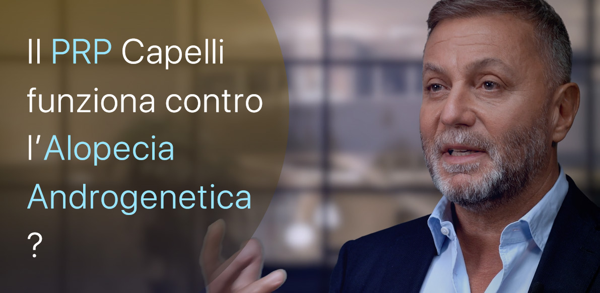 Il PRP Capelli agisce contro l’Alopecia Androgenetica?