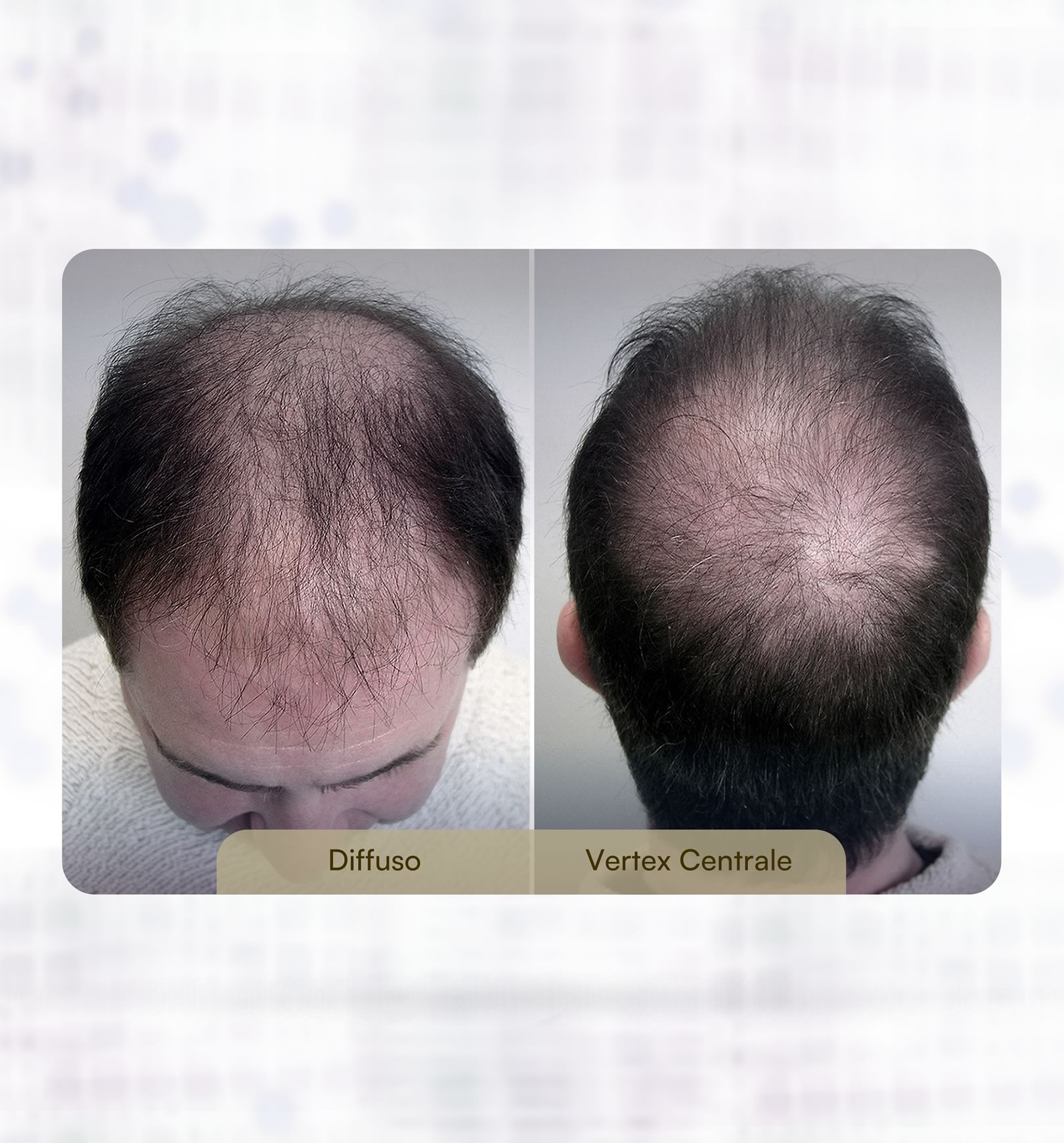 Alopecia Androgenetica maschile: diffuso, vertex centrale, tempie