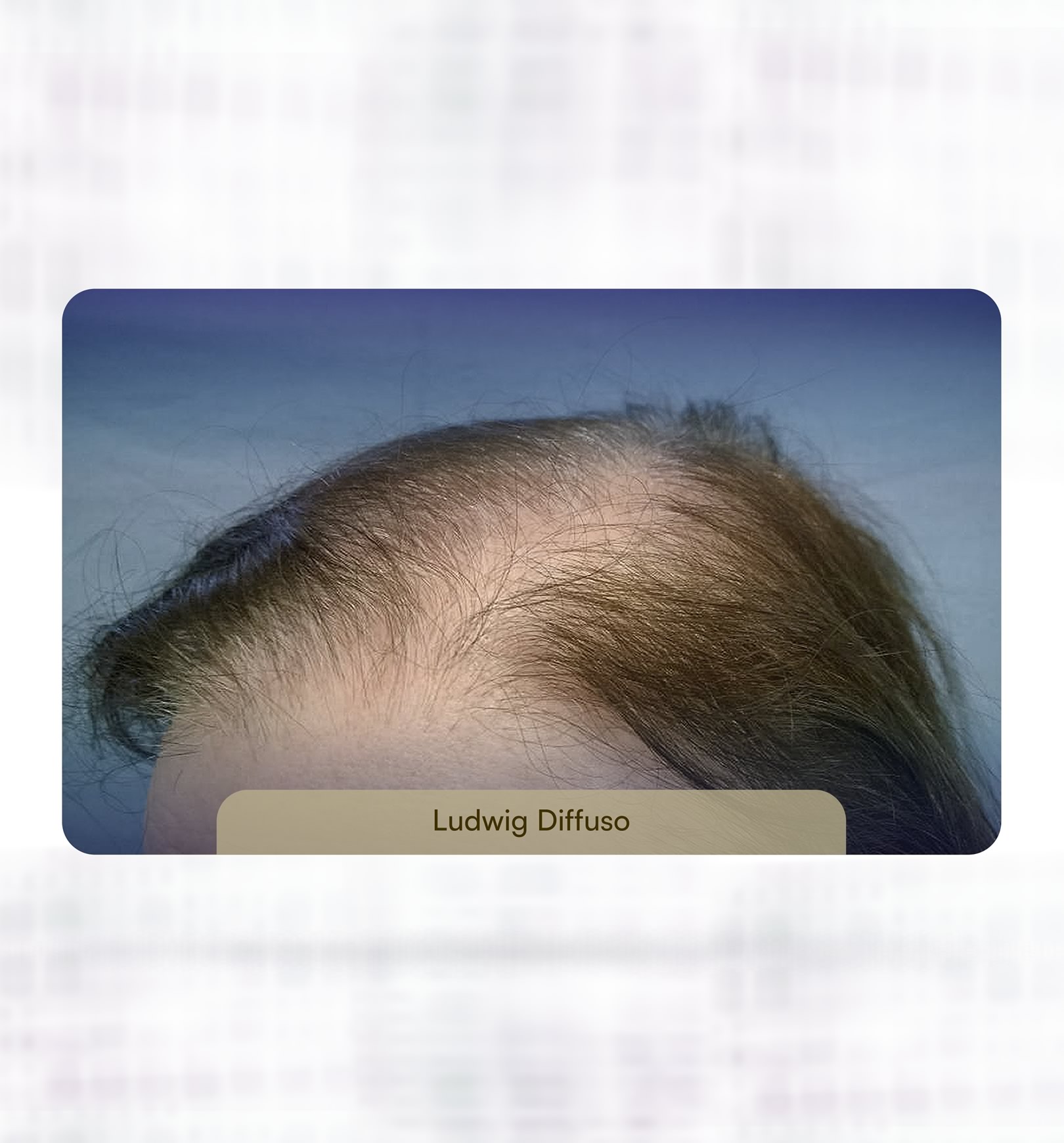 Alopecia Androgenetica femminile: Ludwig diffuso e Ludwig livello 4/5