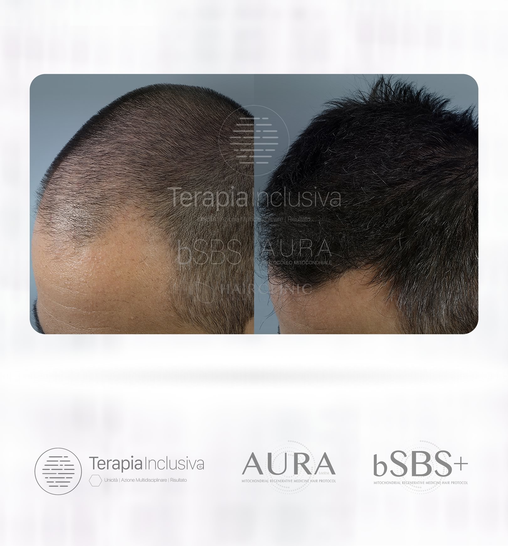 Prima e dopo con la Terapia Inclusiva bSBS e AURA