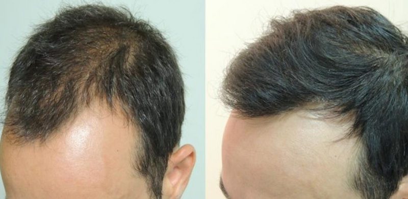 PRP Capelli Ravenna