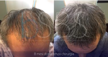 PRP Capelli a Roma