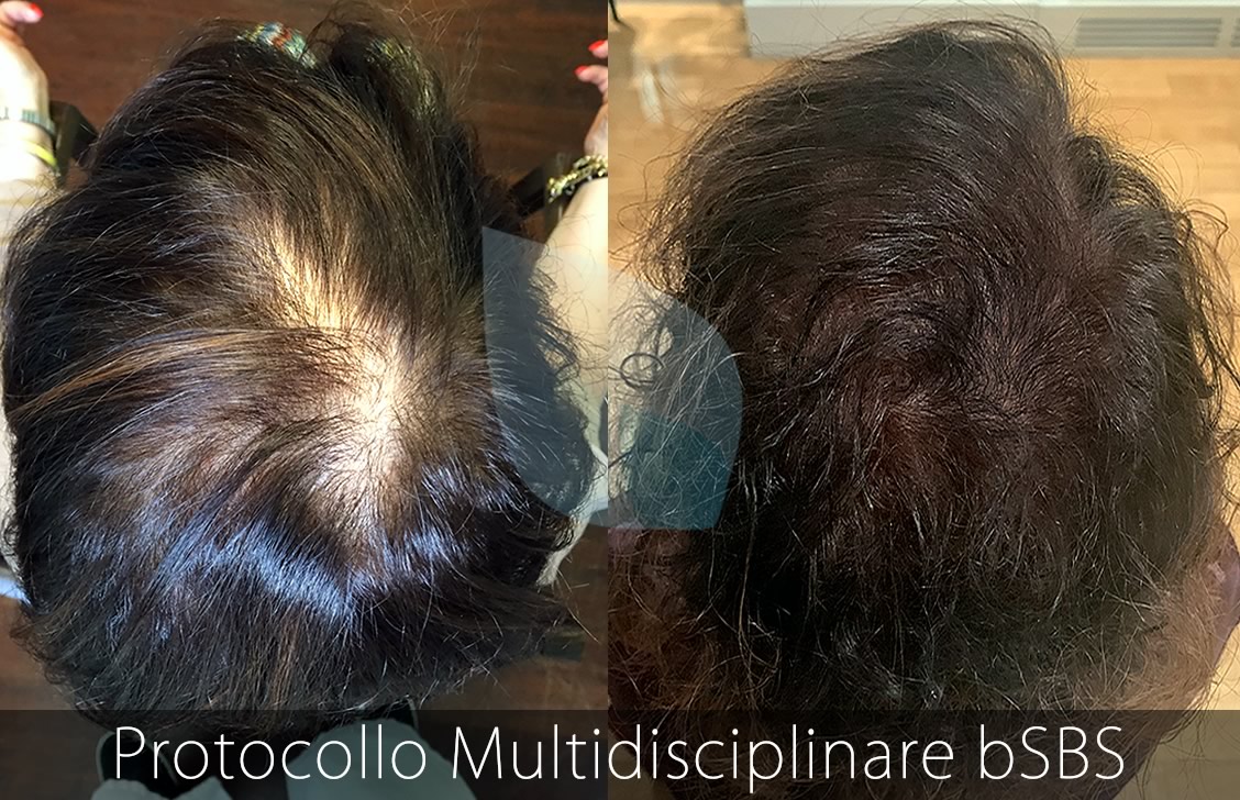 bSBS Capelli, PRP Capelli, Cura Alopecia