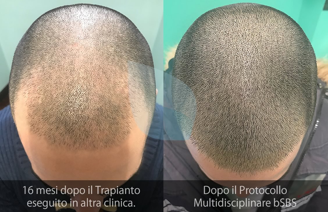 bSBS Capelli, PRP Capelli. Fattori di Crescita