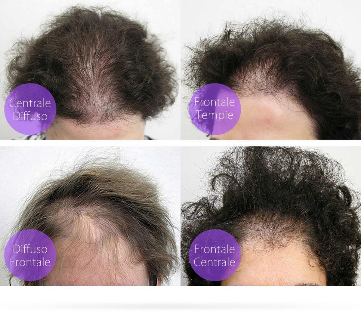 Curare la Calvizie Femminile, Calvizie Femminile e Medicina Rigenerativa, Caduta dei capelli e alopecia femminile