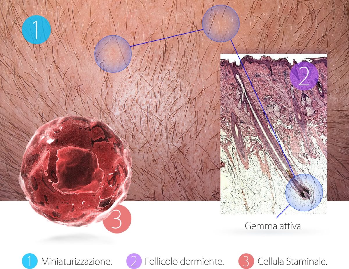 Calvizie e Predisposizione Genetica,