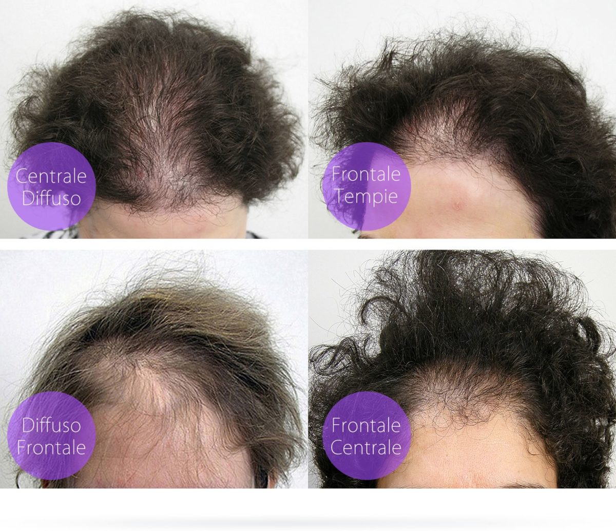 Alopecia e Genetica
