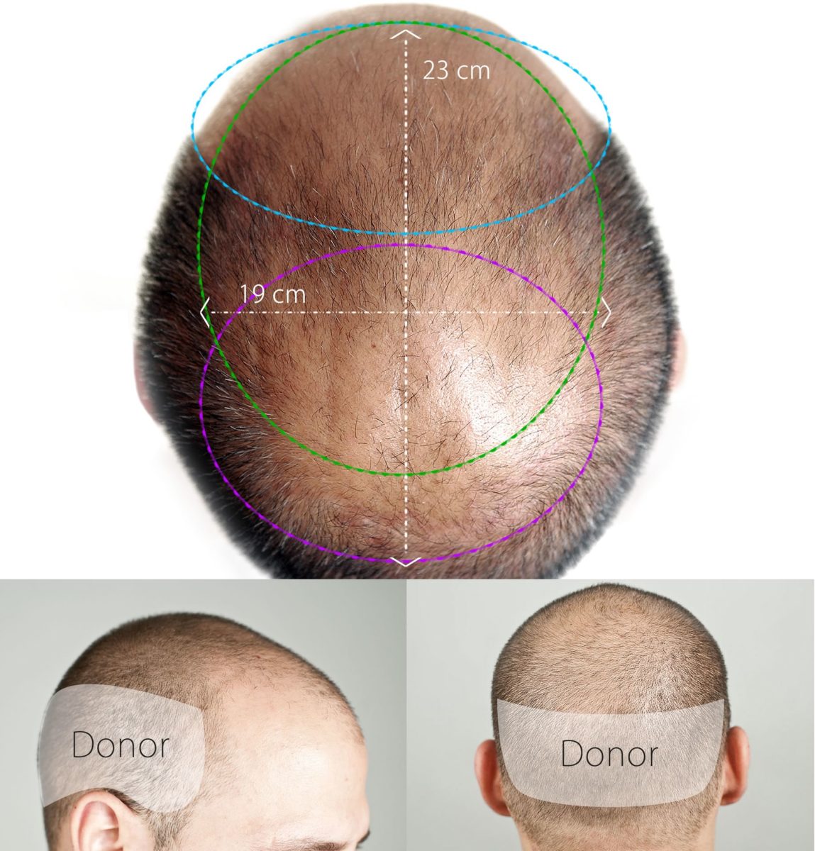 Trapianto Capelli e Periodo Post-Operatorio-FUE, Autotrapianto FUT