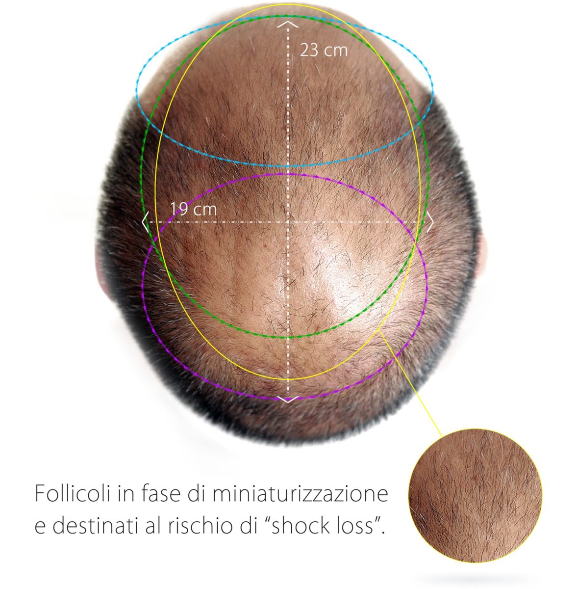 Trapianto di Capelli sempre necessario?