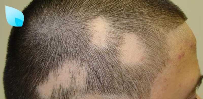 Alopecia Areata Allarme