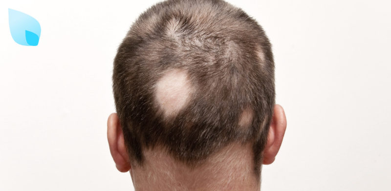 Alopecia Areata bSBS HairClinic