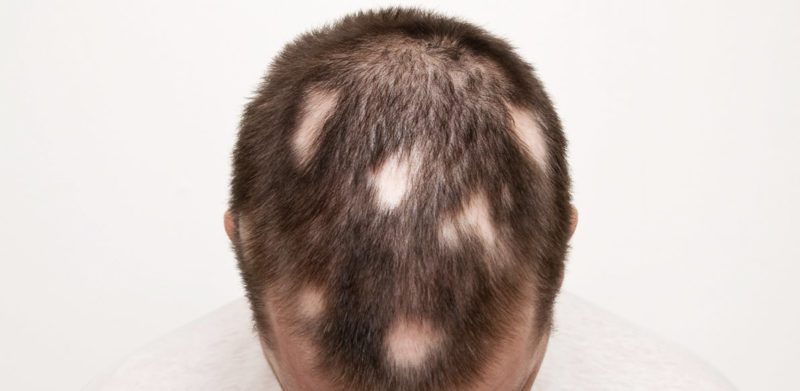 Alopecia Areata e suoi rimedi