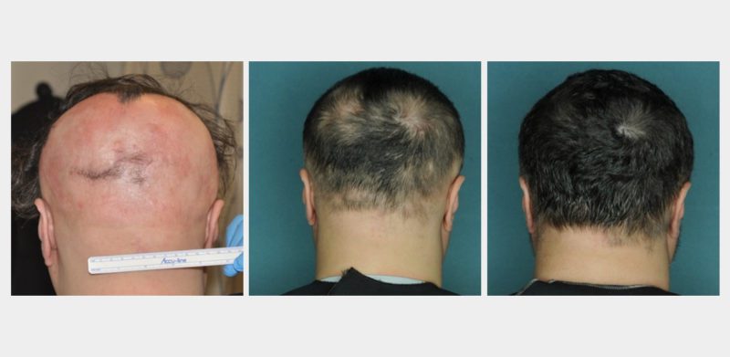 Alopecia Cicatriziale