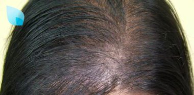 Alopecia Femminile e Finasteride