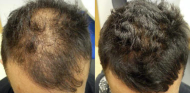 Alopecia Iniziale Cura Metodo Risultati