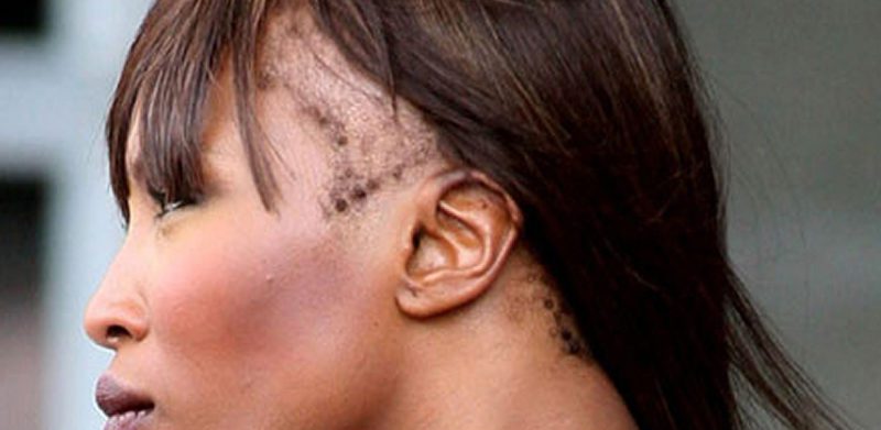Alopecia da Trazione