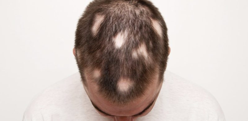 Cura Alopecia Areata