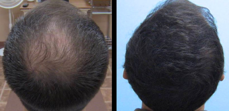 Cura Alopecia Catania