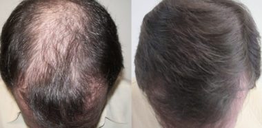 Cura Alopecia Cuneo