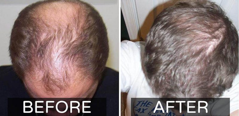 Cura Alopecia Fermo
