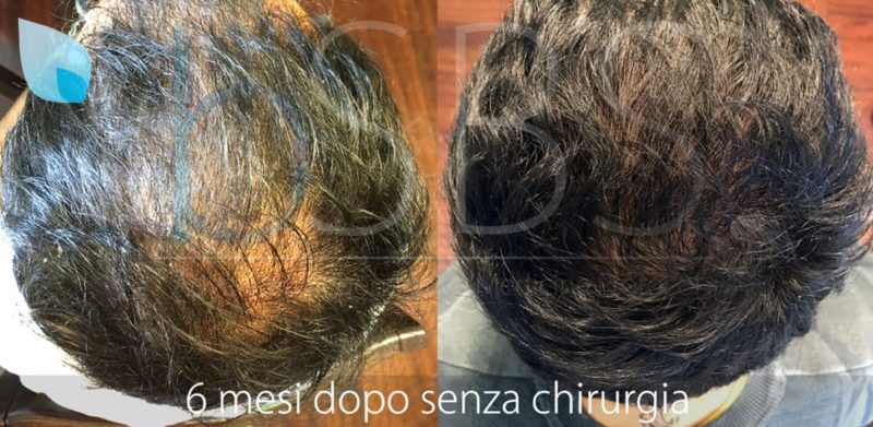 Cura Alopecia Firenze