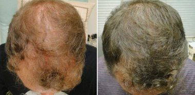 Cura Alopecia Imperia