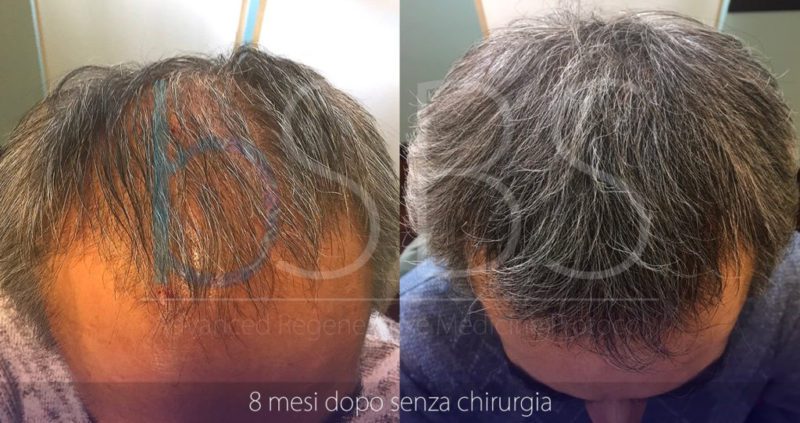 Cura Alopecia Pordenone