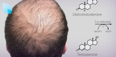 Finasteride Inibitore DHT bSBS HairClinic