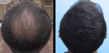 Trapianto di Capelli Padova