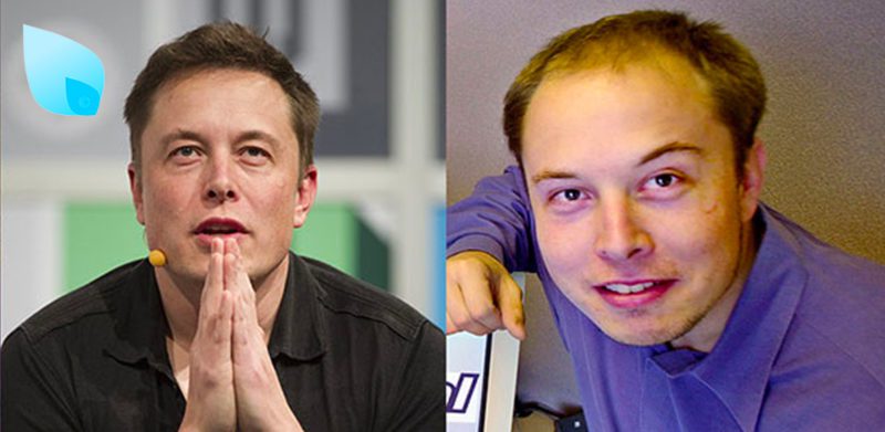 Trapianto Capelli Elon Musk
