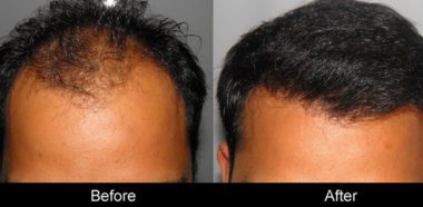 Trapianto Capelli Sondrio