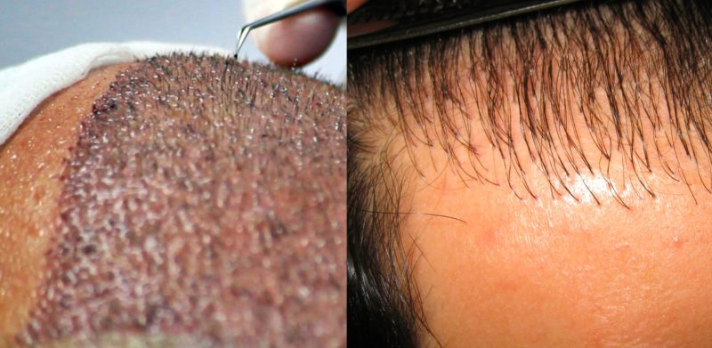 Trapianto di Capelli low cost