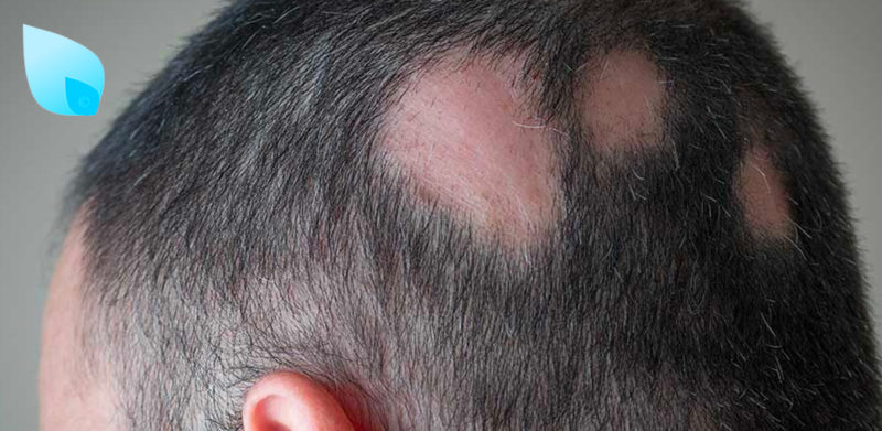 Vitamina D e Alopecia Areata