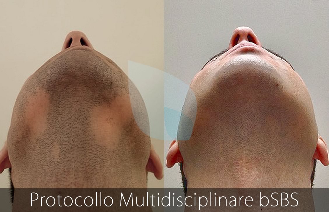 bSBS Capelli, PRP Capelli, hCRP Capelli, Dermatite Seborroica HairClinic