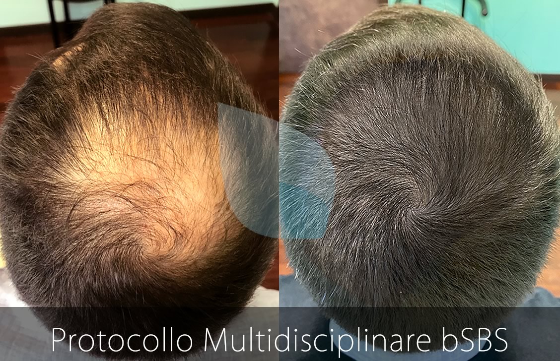 bSBS Capelli, PRP Capelli, hCRP Capelli, La calvizie è un processo naturale