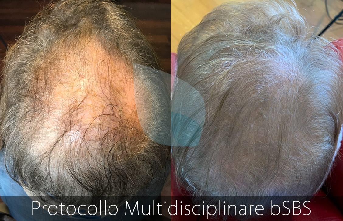 bSBS Capelli, PRP Capelli, hCRP Capelli, Cura Alopecia, Alopecia e Cellule Immunitarie