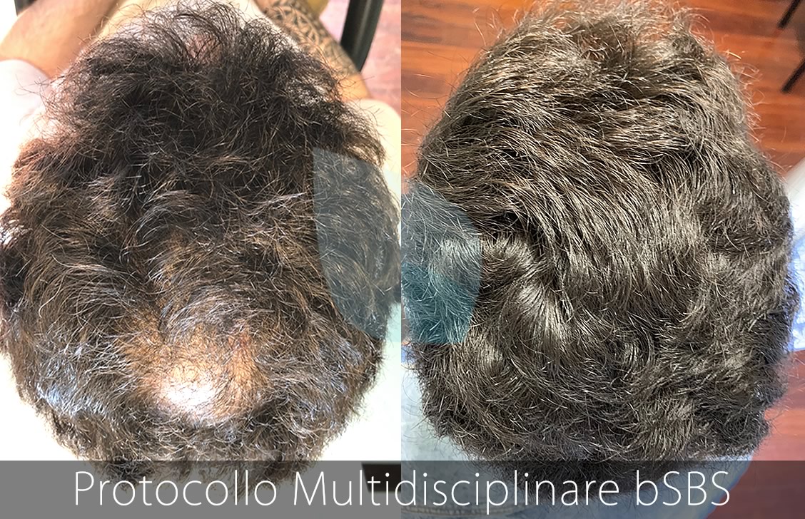 bSBS Capelli, PRP Capelli, hCRP Capelli, Alopecia Iniziale