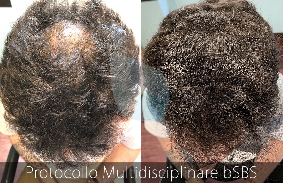 bSBS Capelli, PRP Capelli, hCRP Capelli, Alopecia