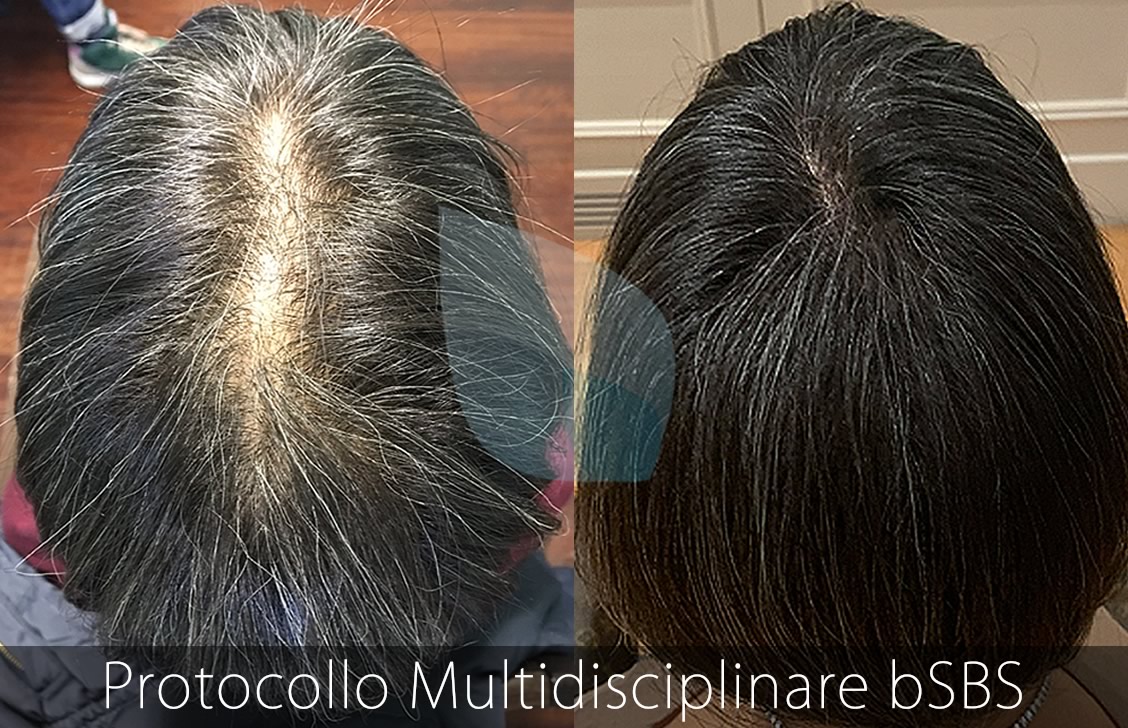 bSBS Capelli, PRP Capelli, hCRP Capelli, L'Alopecia da Trazione
