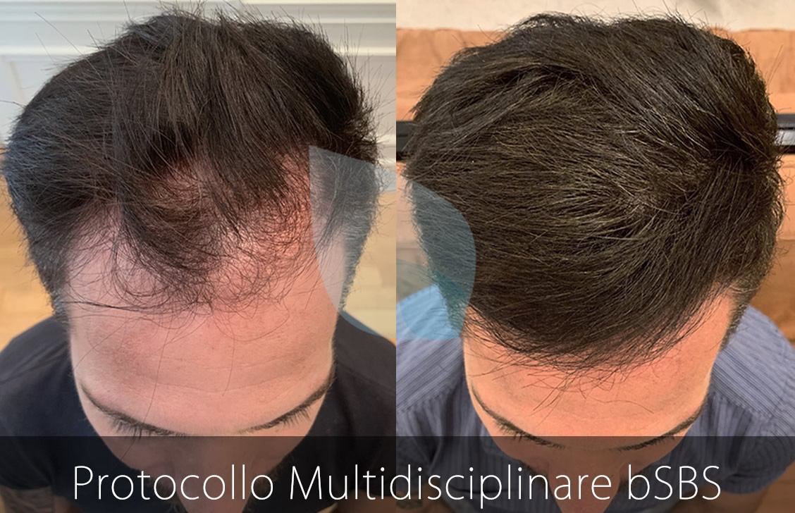 bSBS Capelli, PRP Capelli, hCRP Capelli, Cura Alopecia