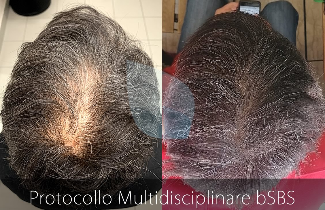 bSBS Capelli, PRP Capelli, hCRP Capelli, Calvizie